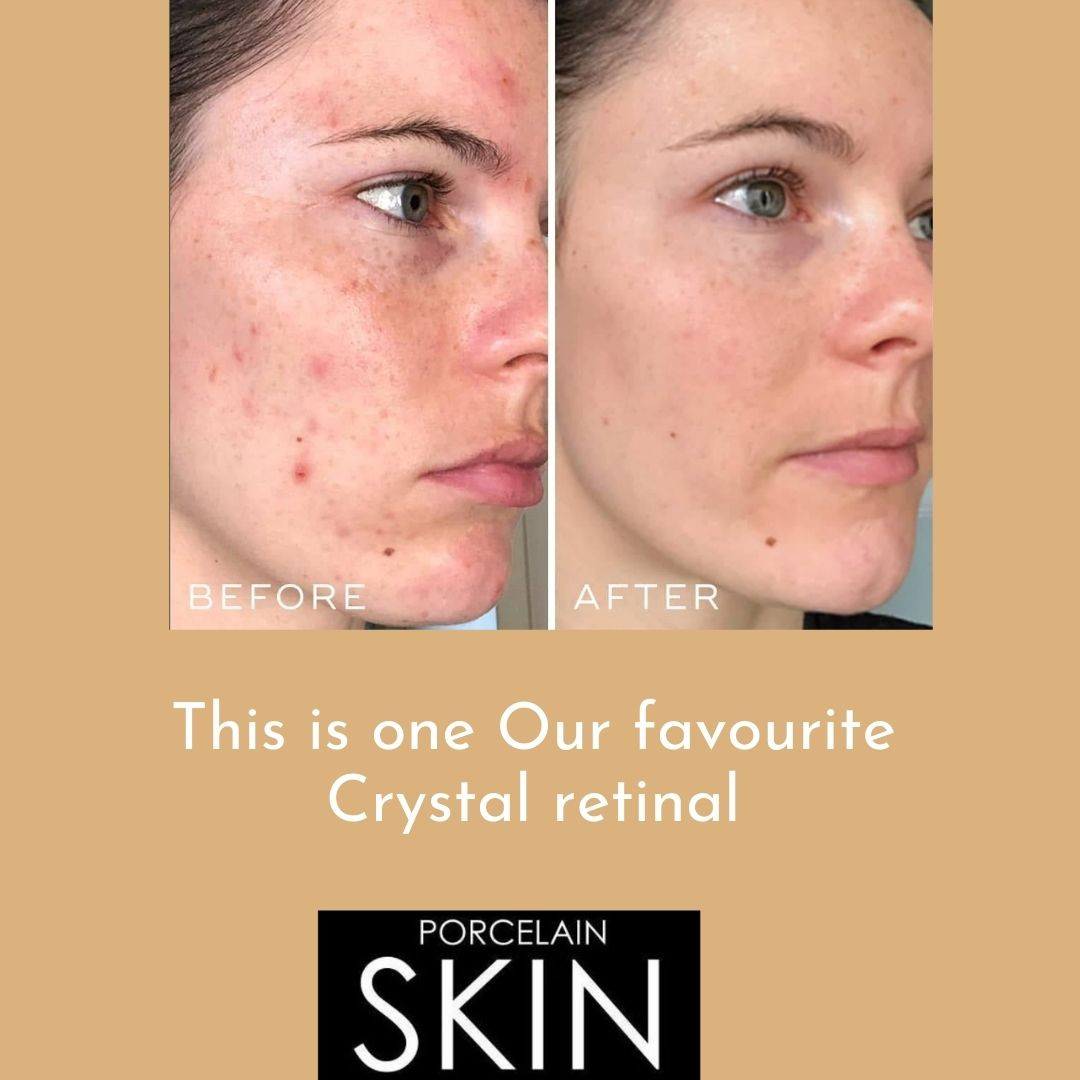 Acne control programme result